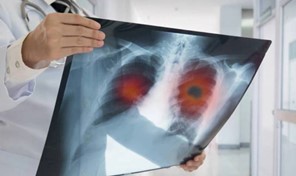 "Ιατρείο Προσυμπτωματικού Ελέγχου Καρκίνου του Πνεύμονα" θα λειτουργήσει στη Λάρισα